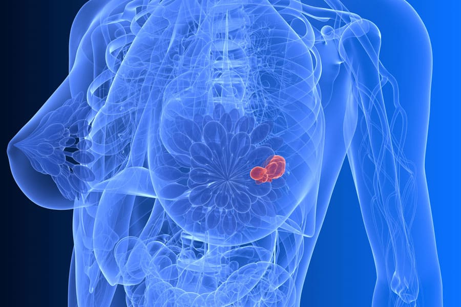 Detection of breast cancer by fluorescence using an optical fiber needle