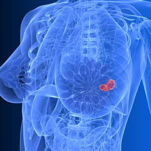 Détection du cancer du sein par fluorescence à l'aide d'une aiguille fibrée